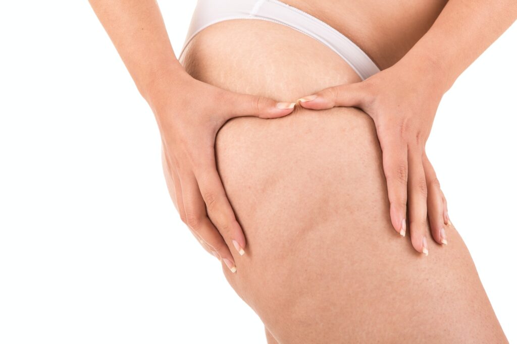 Woman showing her cellulite